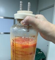 磐石水动力吸脂手术要做多久？
